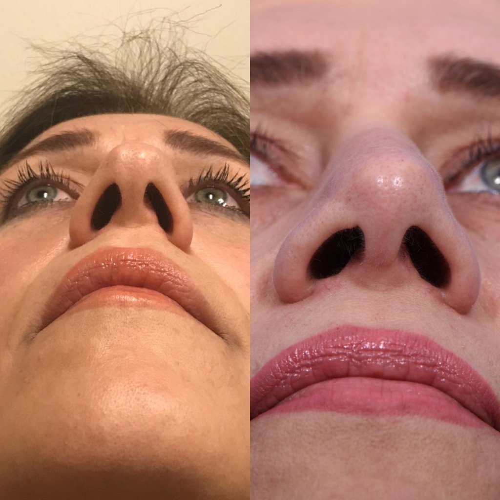 female patient before and after rhinoplasty - front