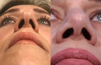 female patient before and after rhinoplasty - front