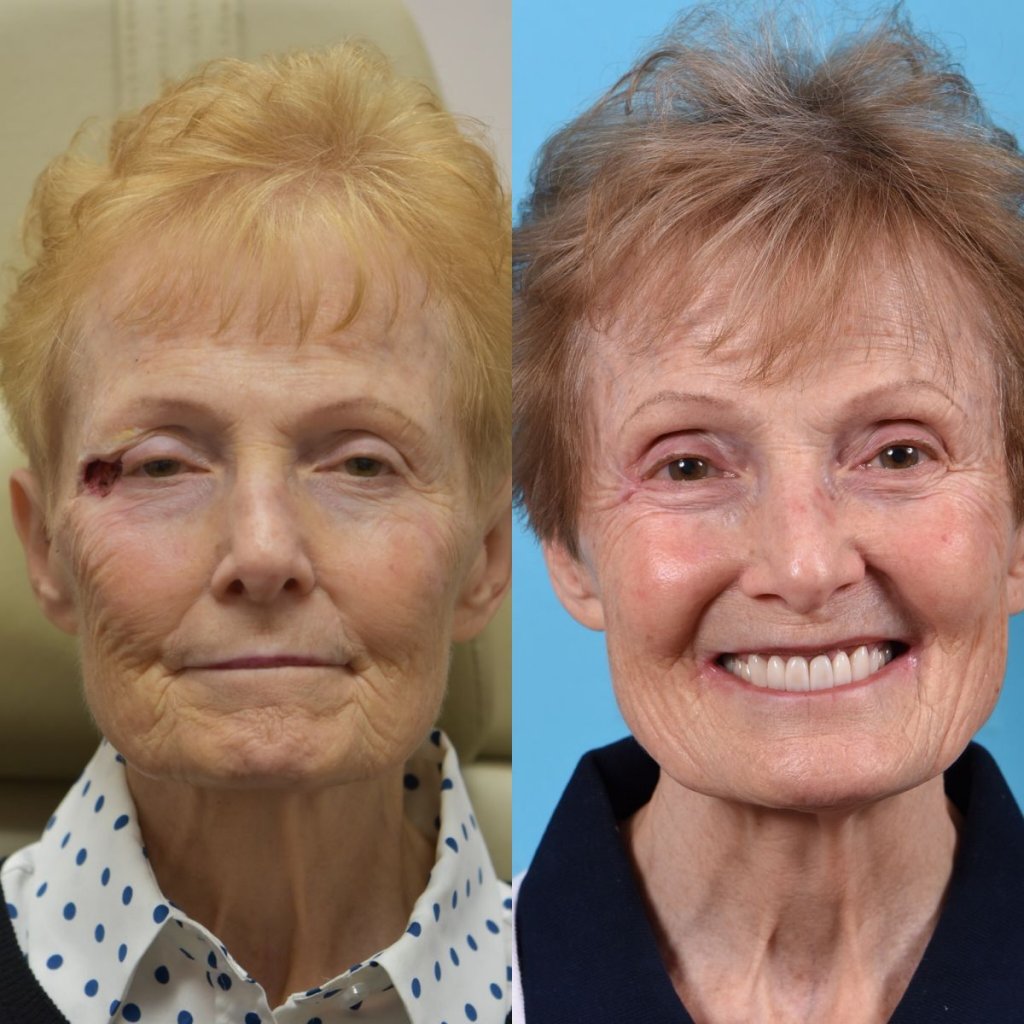 patient before and after right eye area MOHS reconstructive surgery