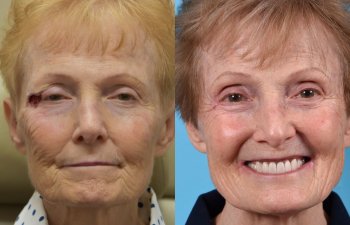 patient before and after right eye area MOHS reconstructive surgery