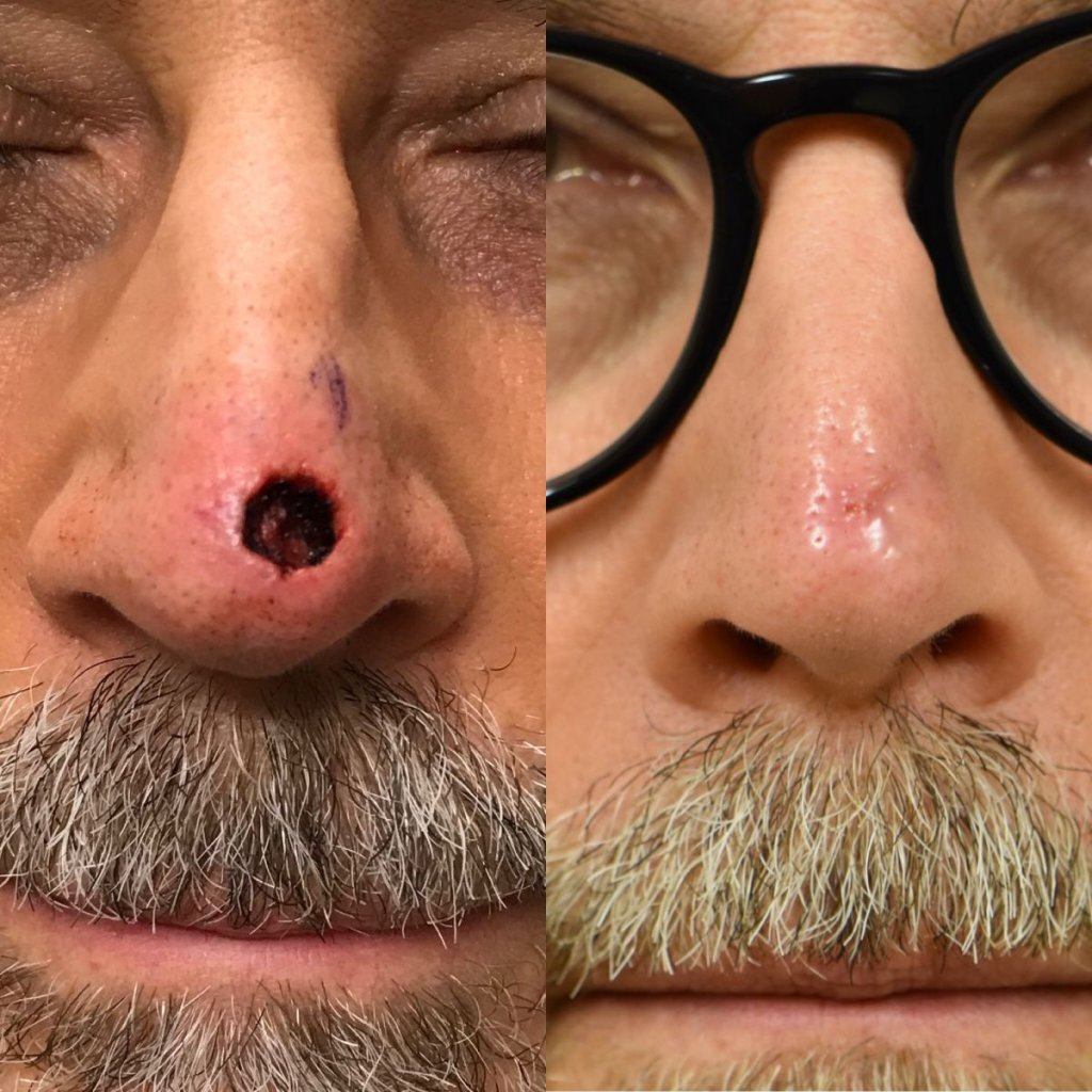 patient before and after nose MOHS reconstructive surgery