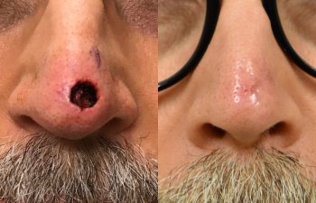 patient before and after nose MOHS reconstructive surgery