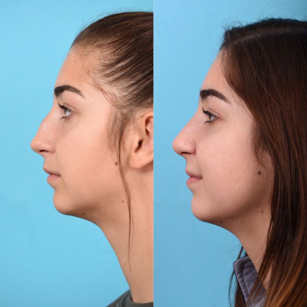 teenage female patient before and after rhinoplasty - left side