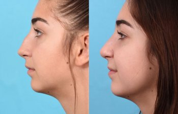 teenage female patient before and after rhinoplasty - left side