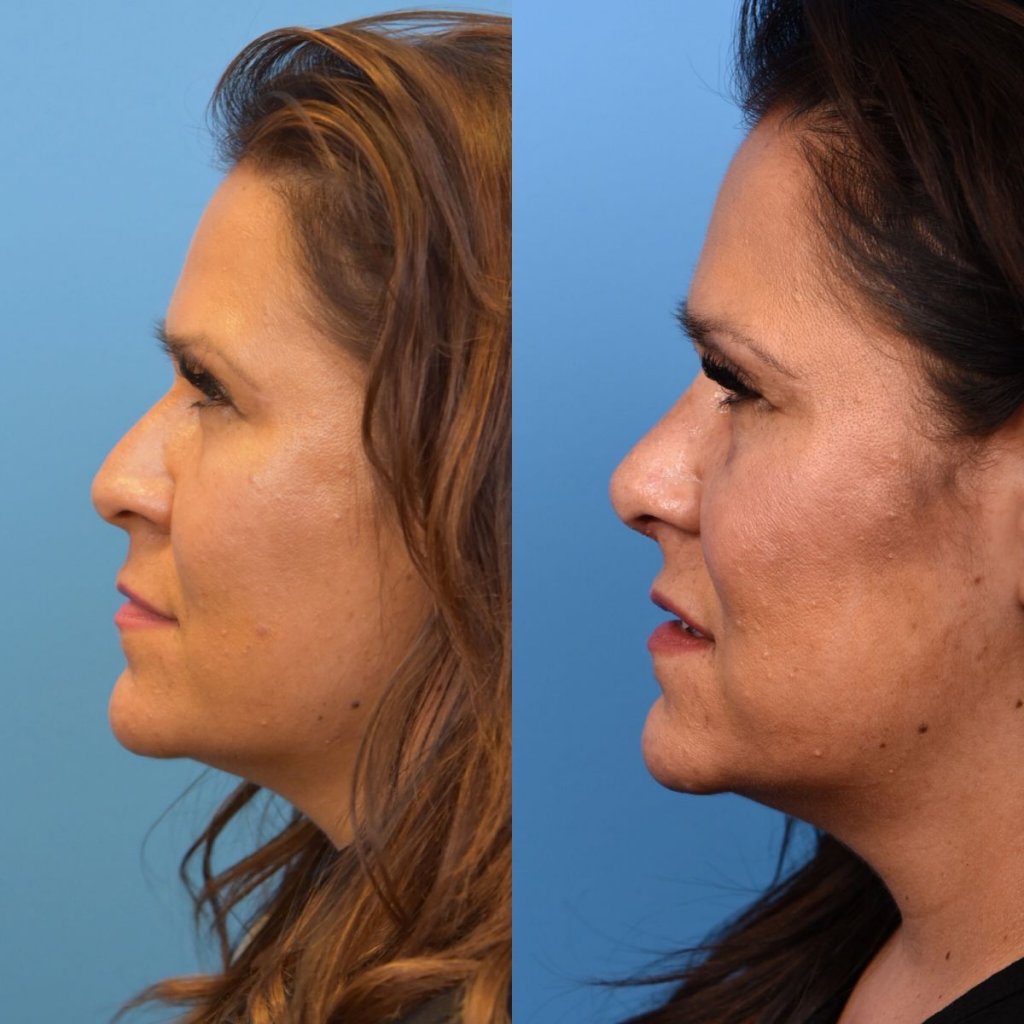 female patient before and after rhinoplasty - left side