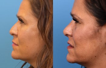 female patient before and after rhinoplasty - left side