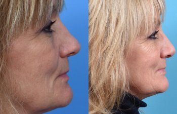 female patient before and after rhinoplasty - right side