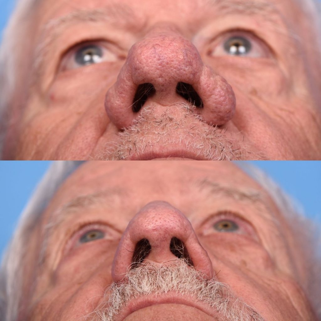 male patient before and after nasal reconstructive surgery