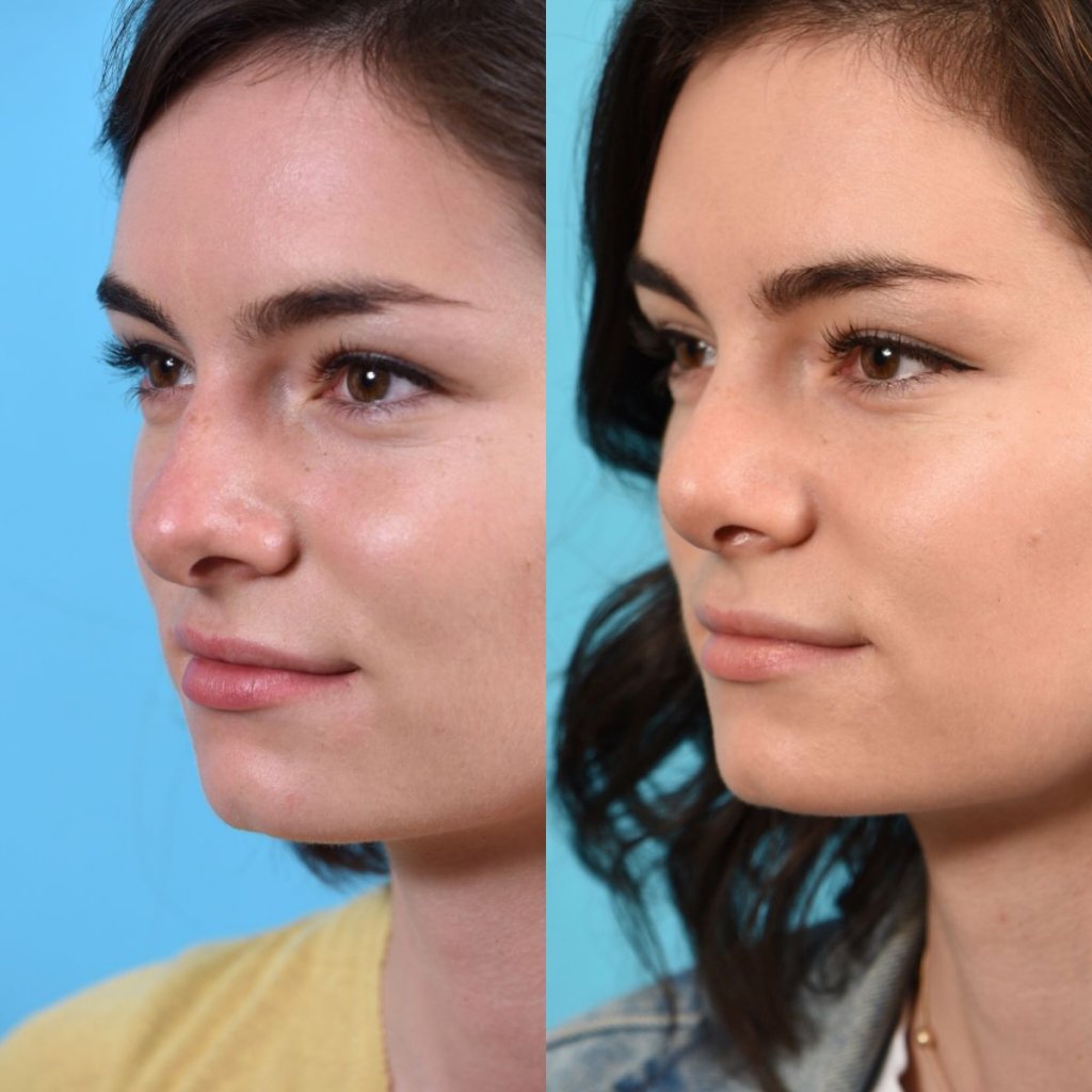 female patient before and after rhinoplasty - left side