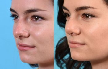 female patient before and after rhinoplasty - left side