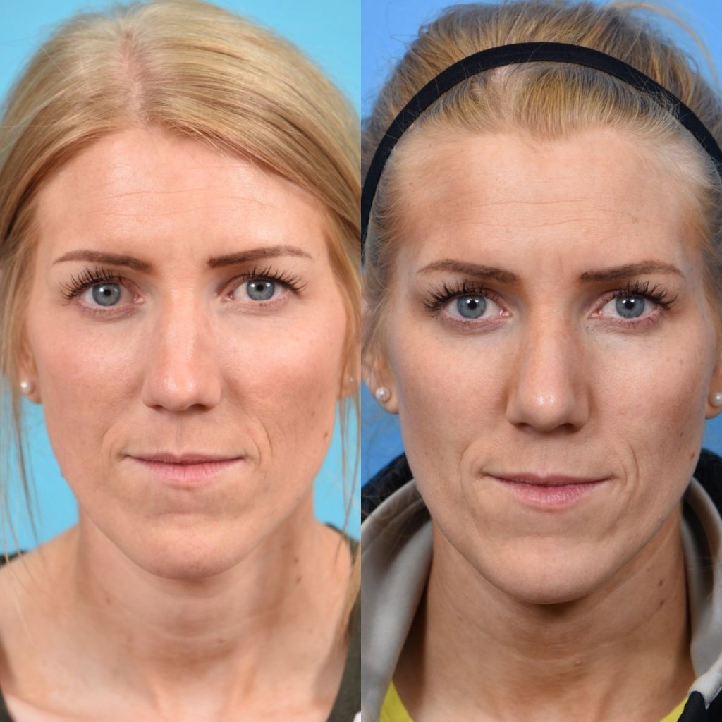 female patient before and after rhinoplasty - front