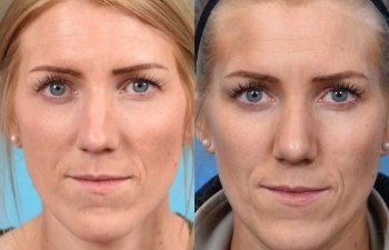 female patient before and after rhinoplasty - front