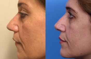 female patient before and after rhinoplasty - left side