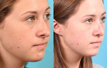 teenage girl before and after rhinoplasty - right side
