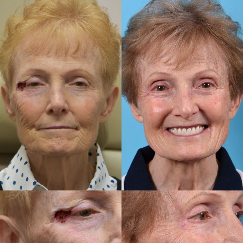 patient before and after right eye area MOHS reconstructive surgery