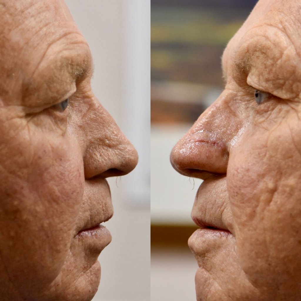 patient before and after nasal reconstructive surgery