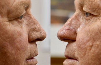 patient before and after nasal reconstructive surgery