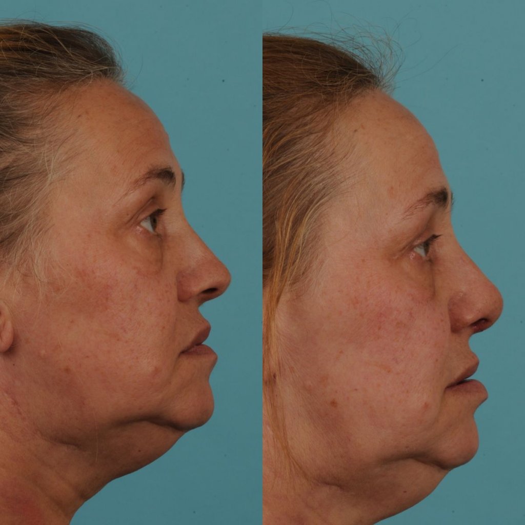 female patient before and after rhinoplasty - right side