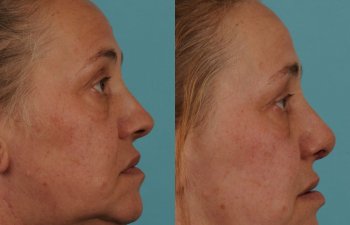 female patient before and after rhinoplasty - right side