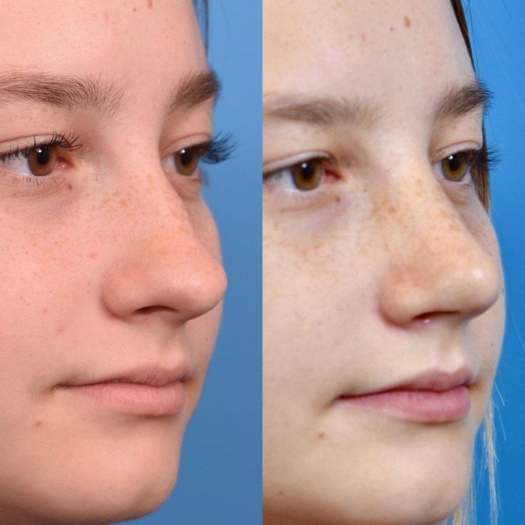 teenage girl before and after rhinoplasty - right side