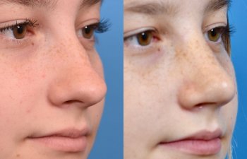 teenage girl before and after rhinoplasty - right side