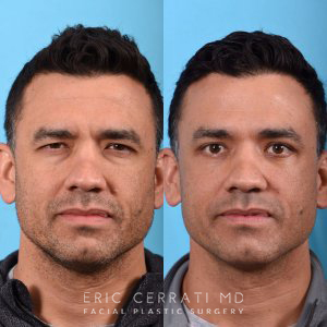 male patient before and after blepharoplasty