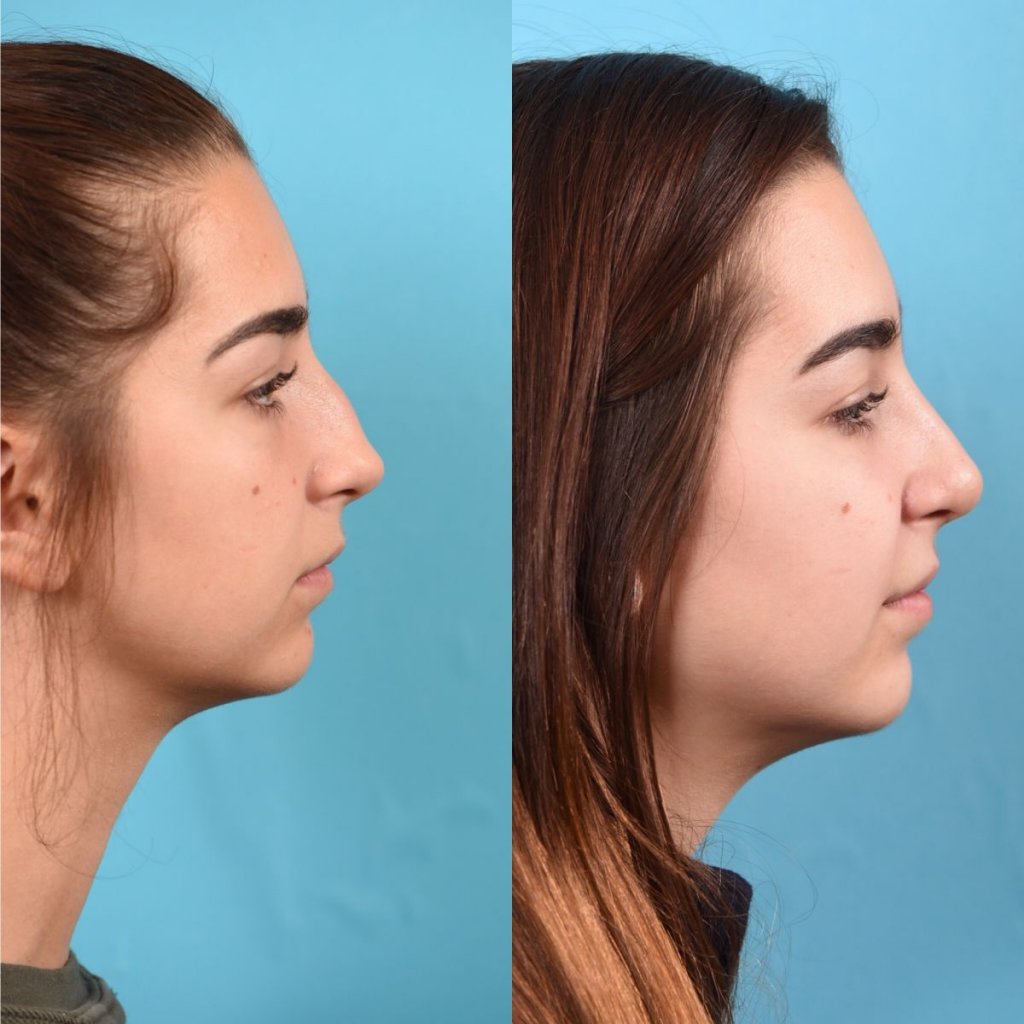 teenage female patient before and after rhinoplasty - right side