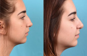 teenage female patient before and after rhinoplasty - right side