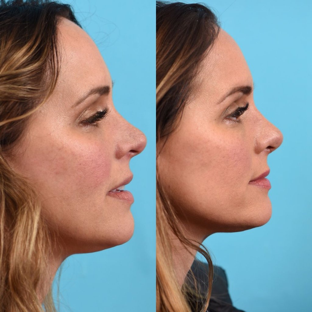 female patient before and after rhinoplasty - right side