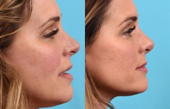 female patient before and after rhinoplasty - right side