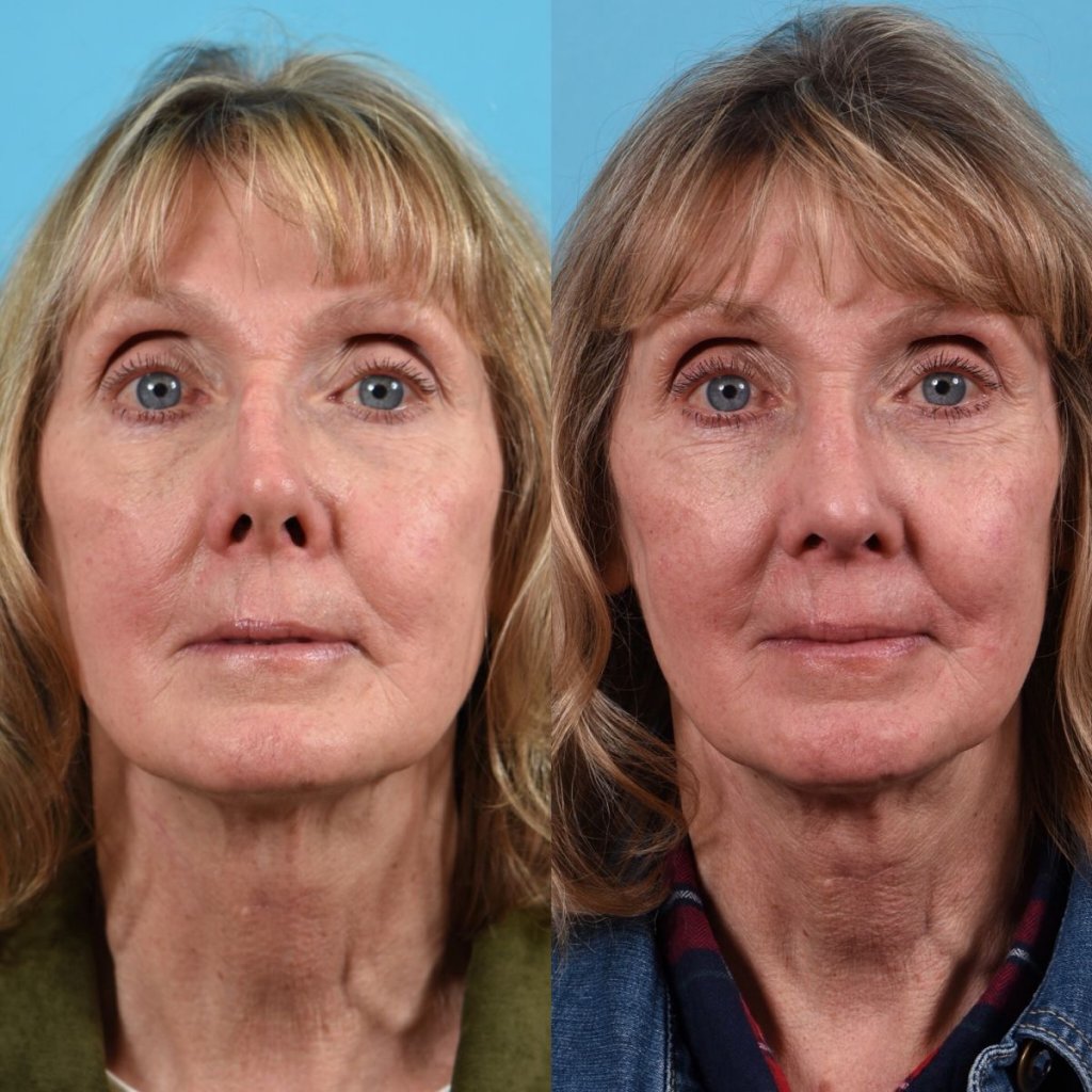 female patient before and after rhinoplasty - front