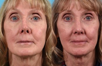 female patient before and after rhinoplasty - front