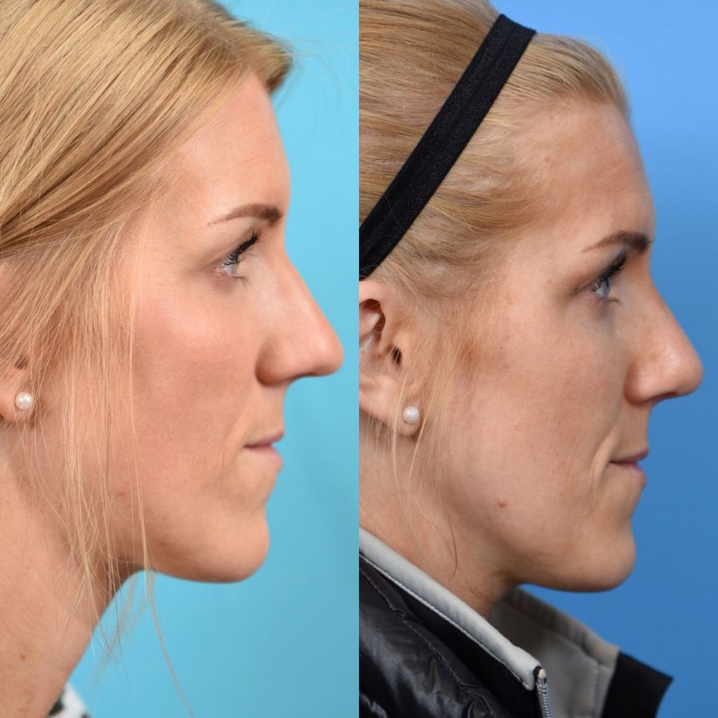 female patient before and after rhinoplasty - right side