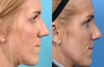 female patient before and after rhinoplasty - right side