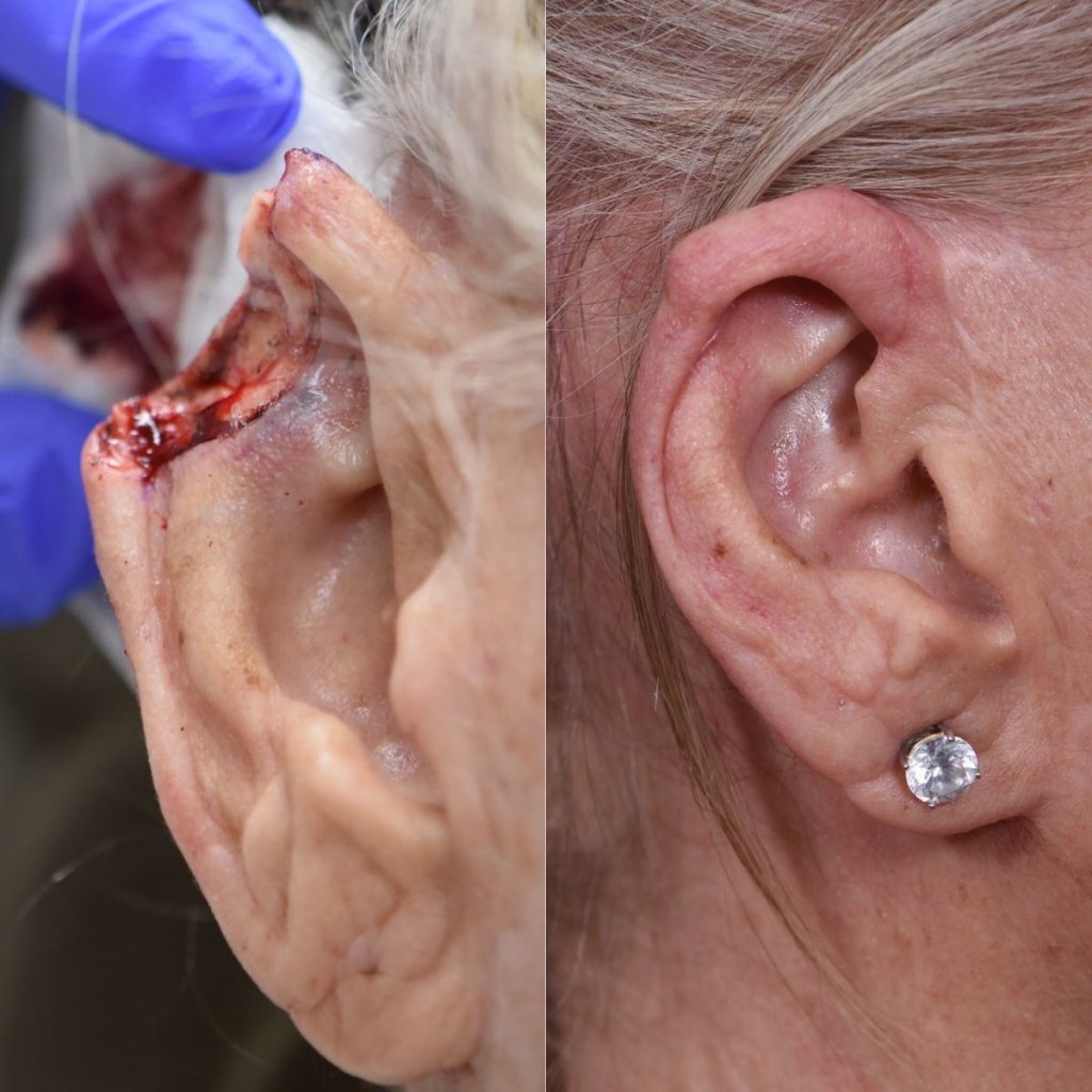 patient before and after right ear MOHS reconstructive surgery