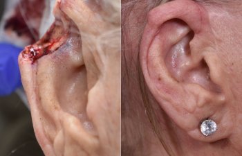 patient before and after right ear MOHS reconstructive surgery