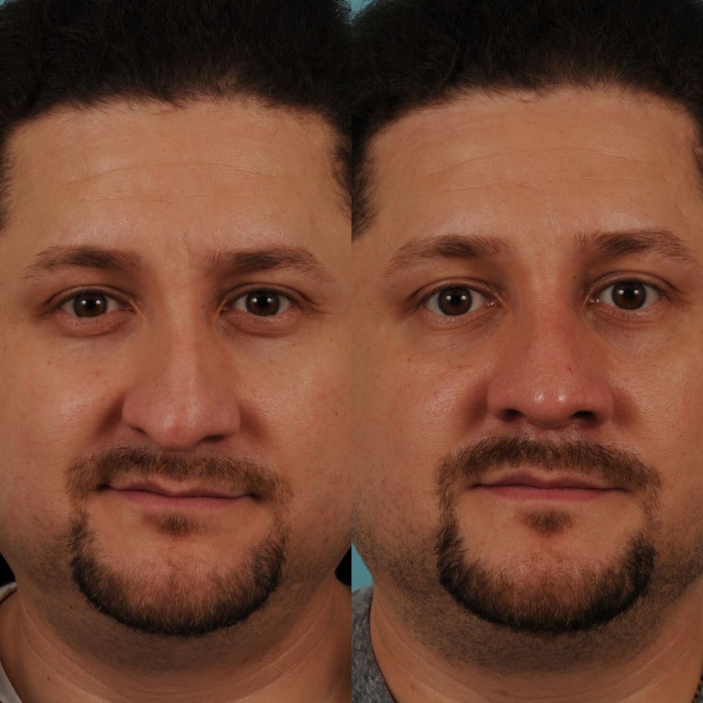male patient before and after rhinoplasty - front