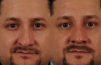male patient before and after rhinoplasty - front