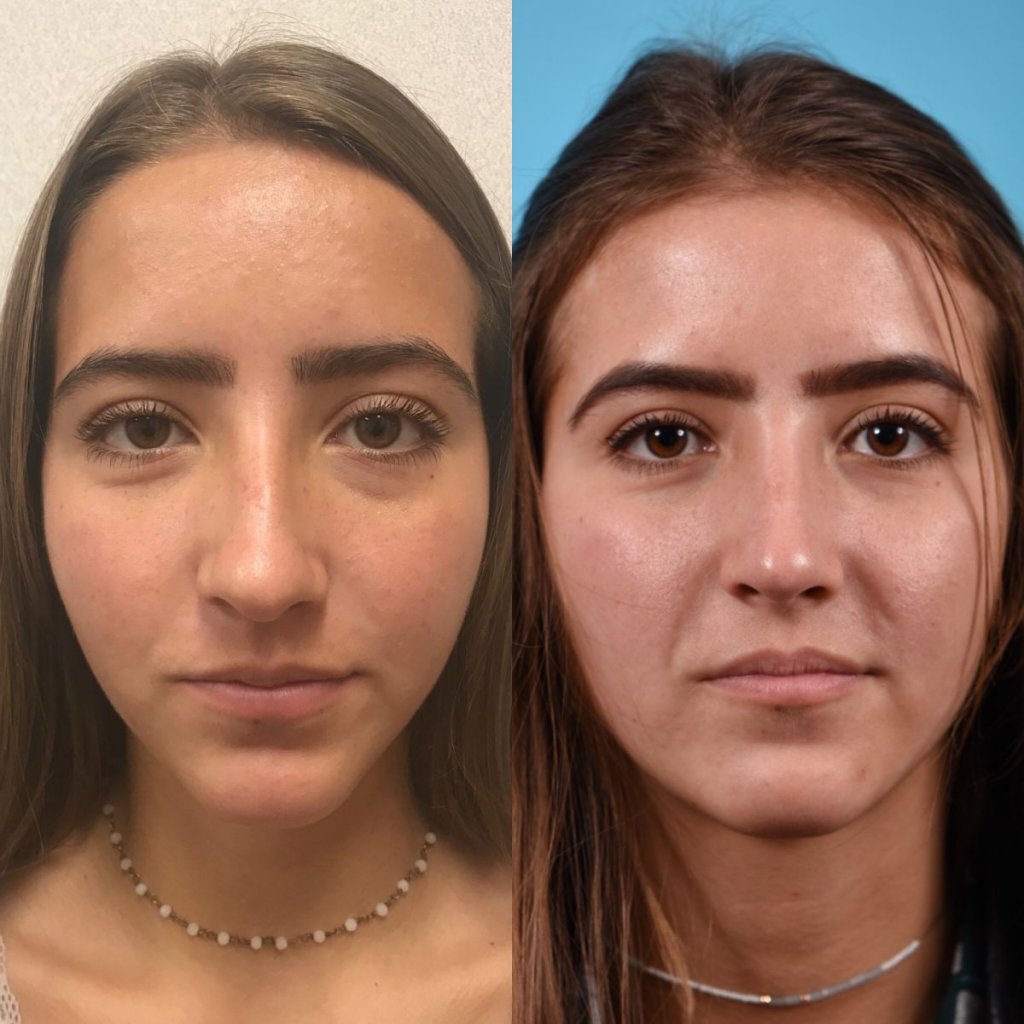 female patient before and after rhinoplasty - front