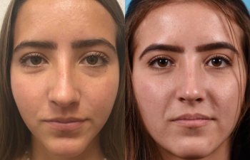 female patient before and after rhinoplasty - front