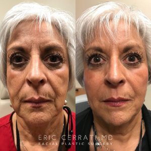 female patient before and after facial injectable treatment