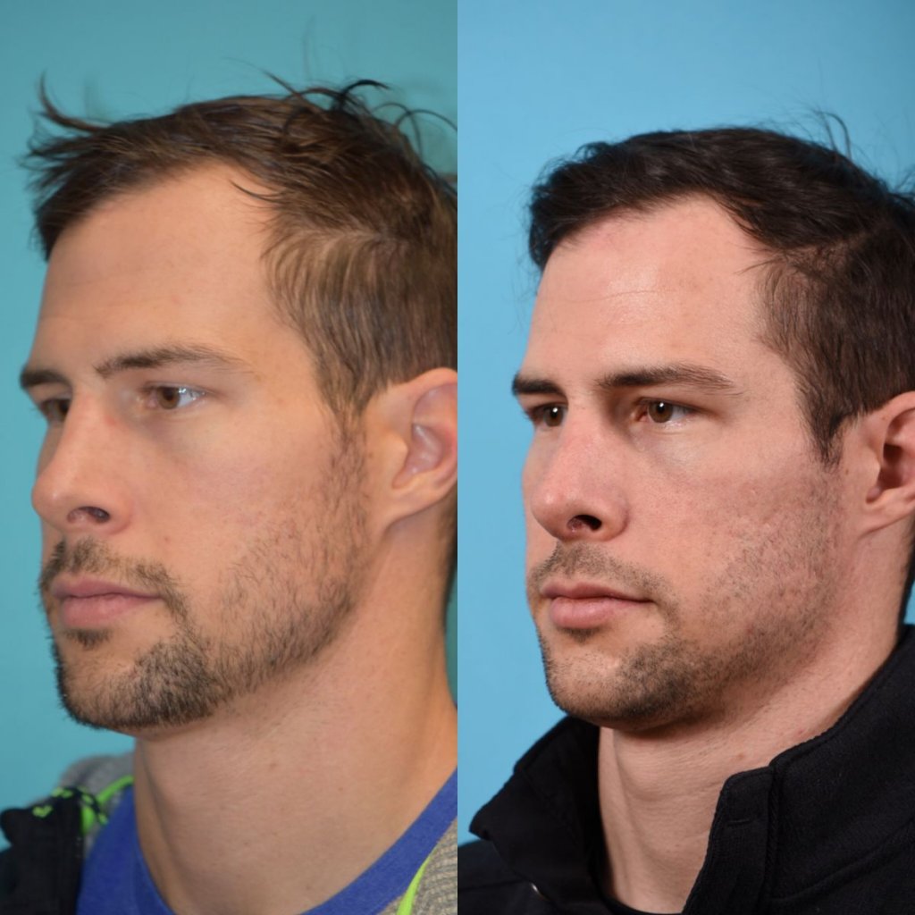 male patient before and after rhinoplasty - left side