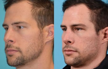 male patient before and after rhinoplasty - left side