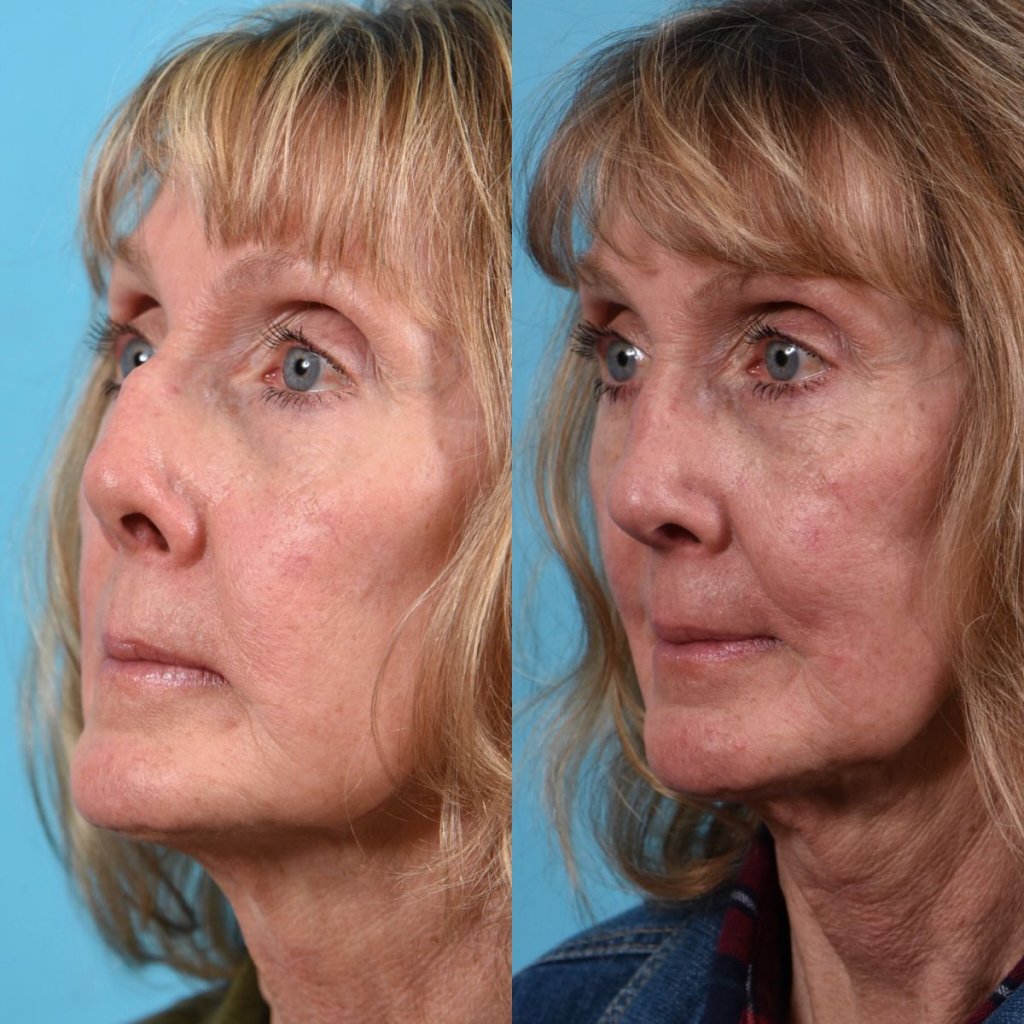 female patient before and after rhinoplasty - left side