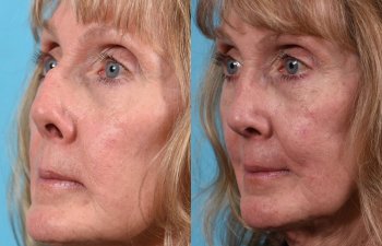 female patient before and after rhinoplasty - left side