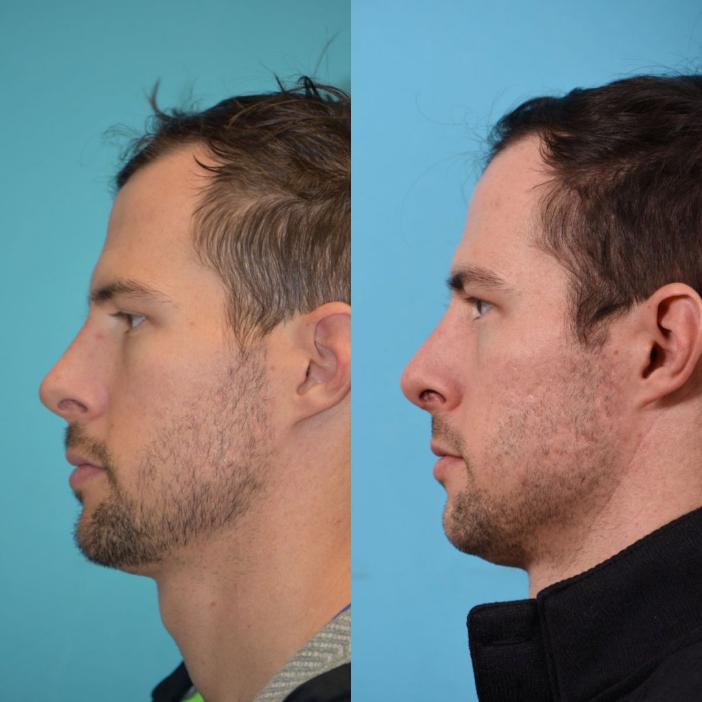 male patient before and after rhinoplasty - left side