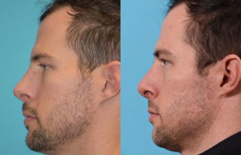 male patient before and after rhinoplasty - left side