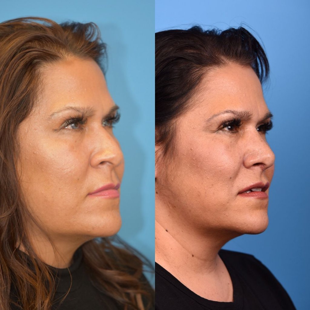female patient before and after rhinoplasty - right side