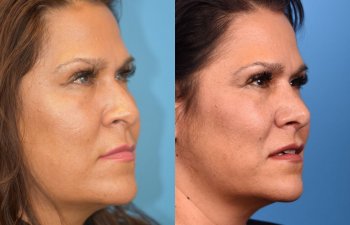 female patient before and after rhinoplasty - right side