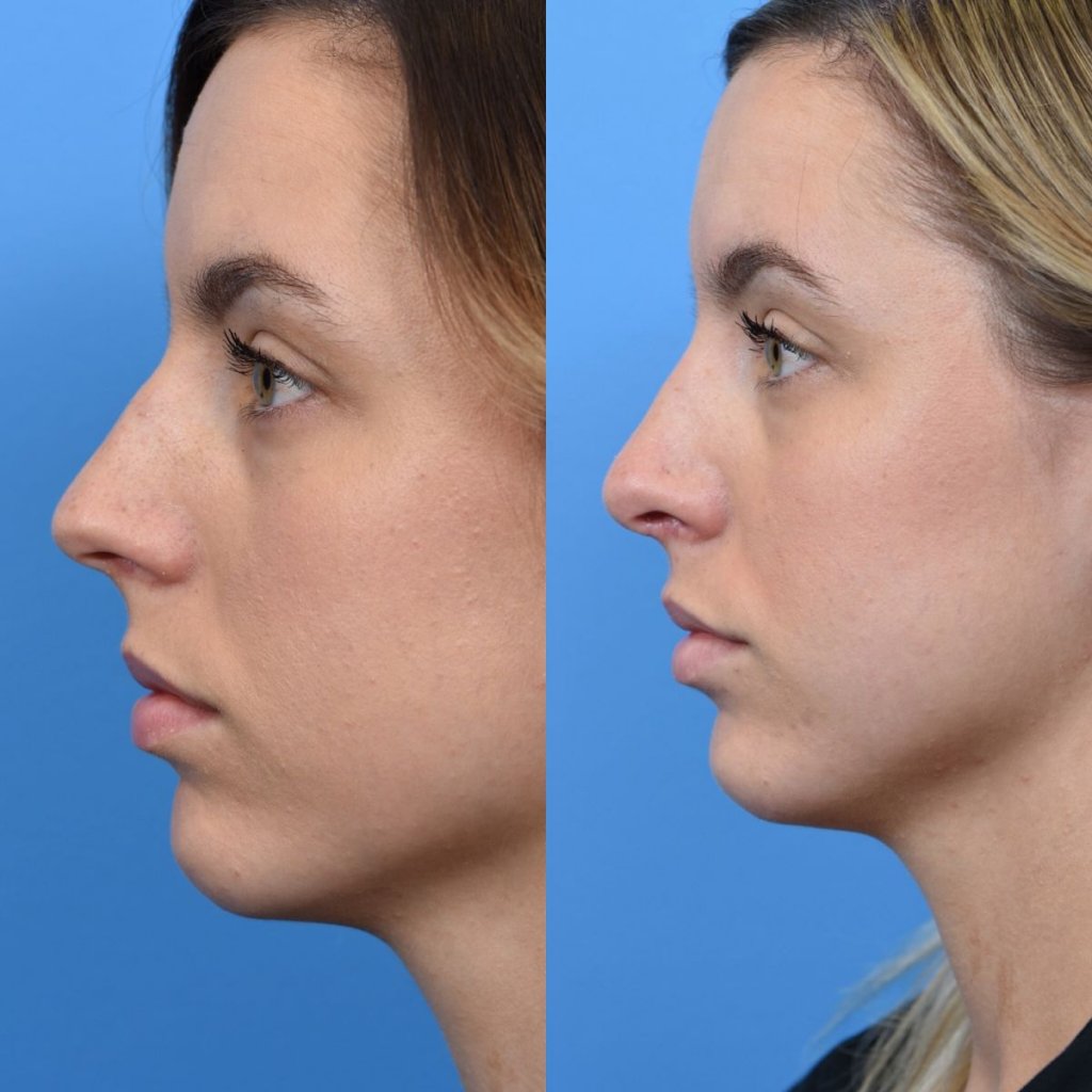young female patient before and after rhinoplasty - left side